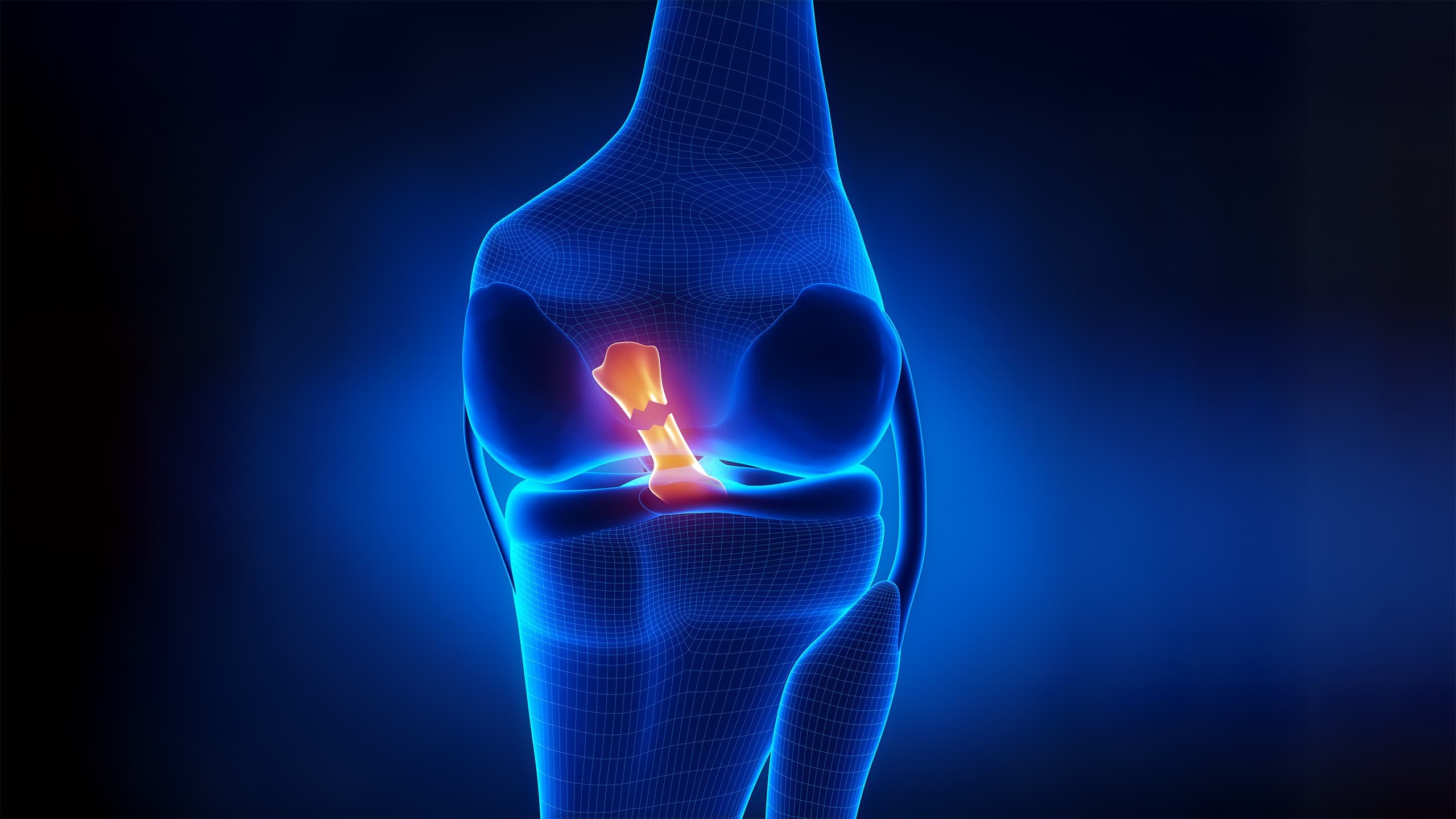 Schéma du ligament croisé antérieur — anatomie