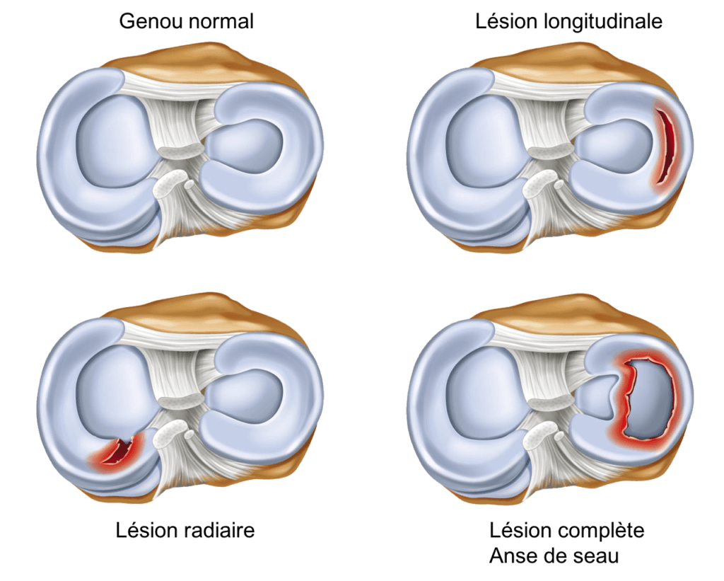 Types de lésions méniscales pouvant nécessiter une méniscectomie