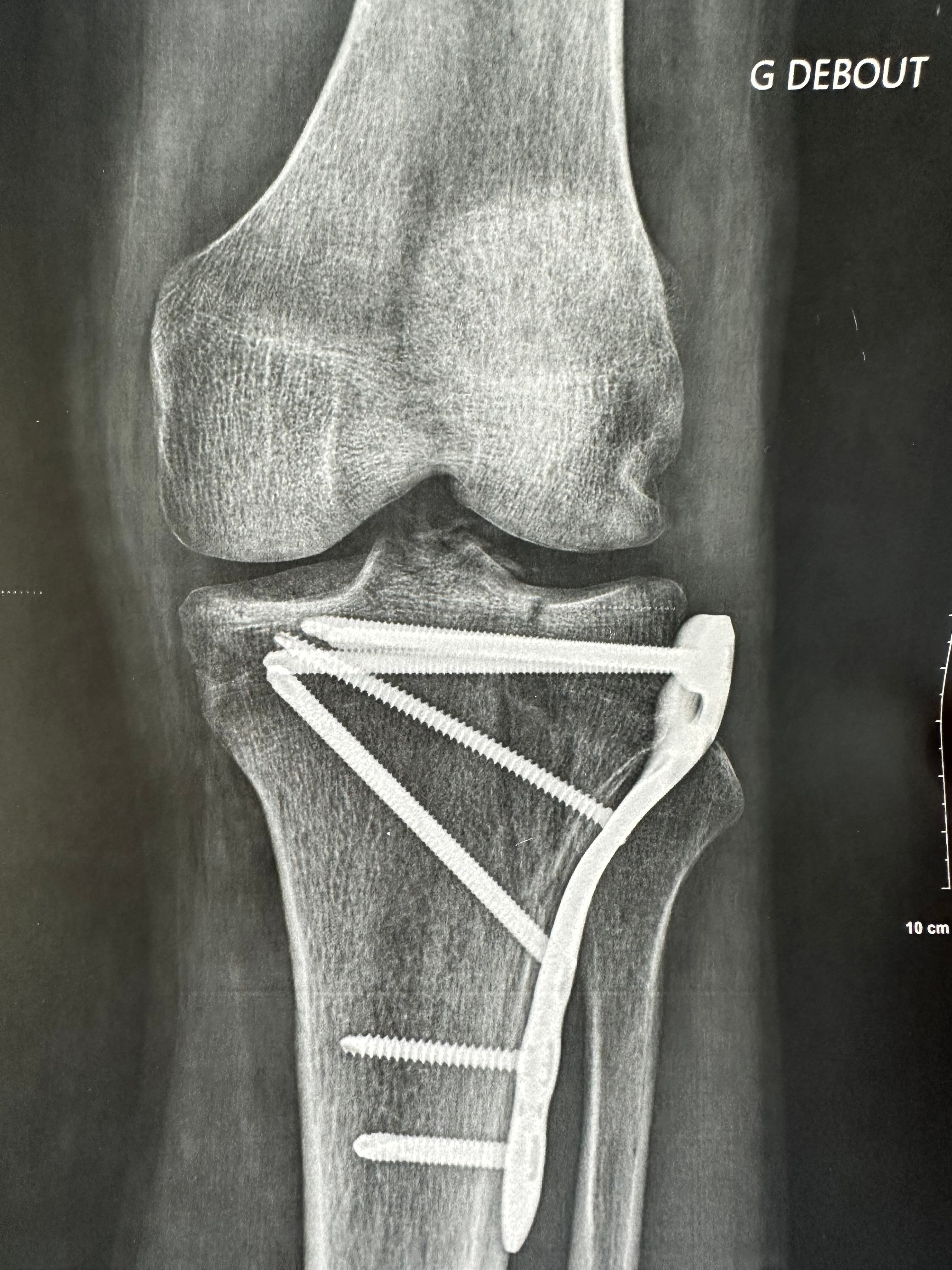 Contrôle radiologique post-opératoire — ostéosynthèse plateau tibial