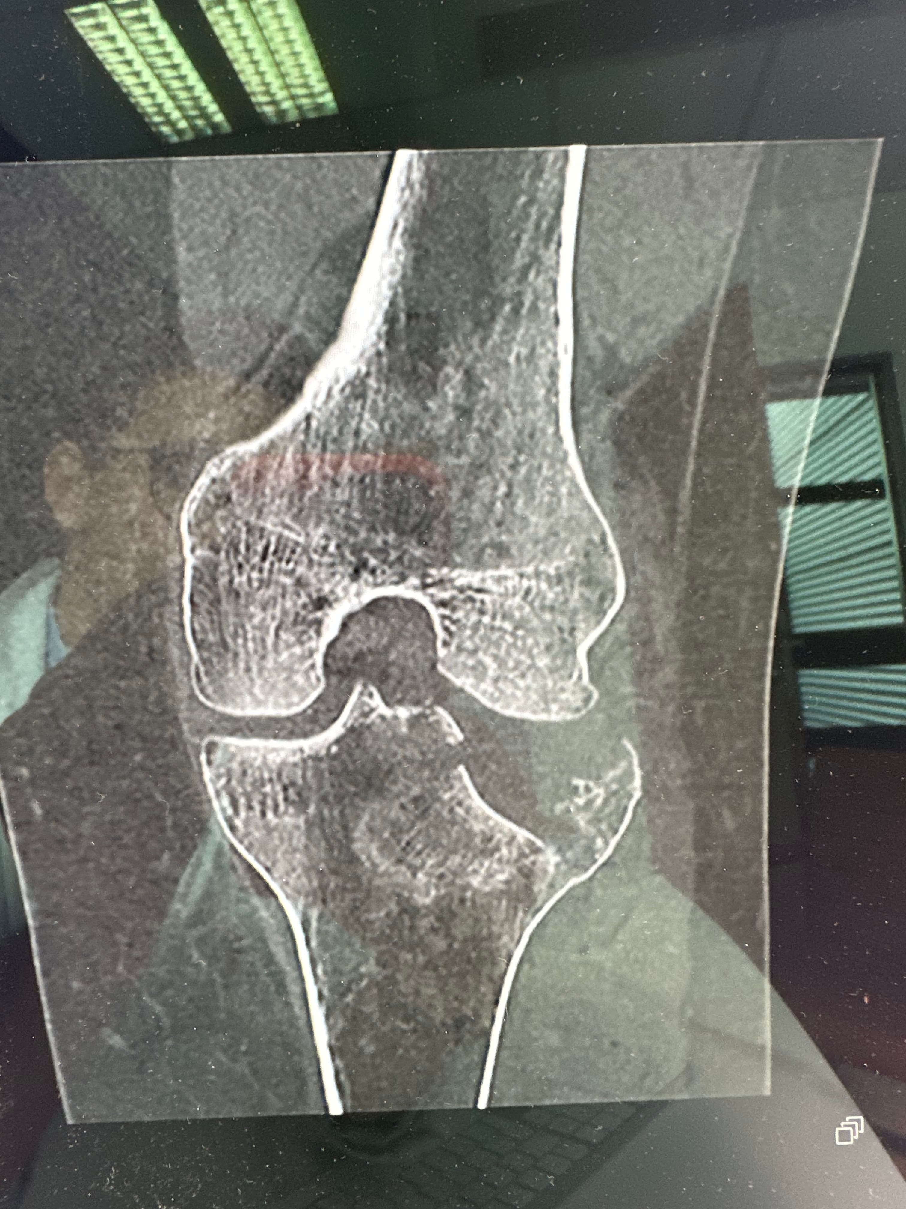 Scanner préopératoire du plateau tibial