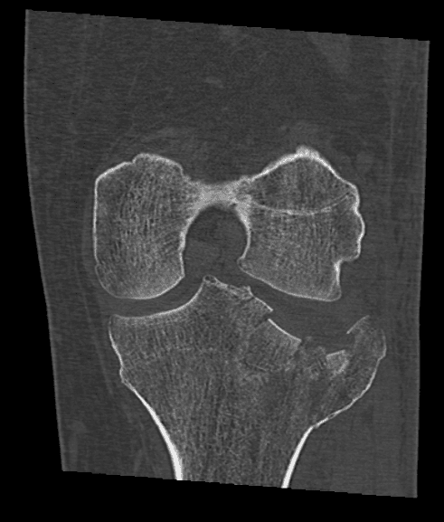 Scanner préopératoire d'une fracture du plateau tibial