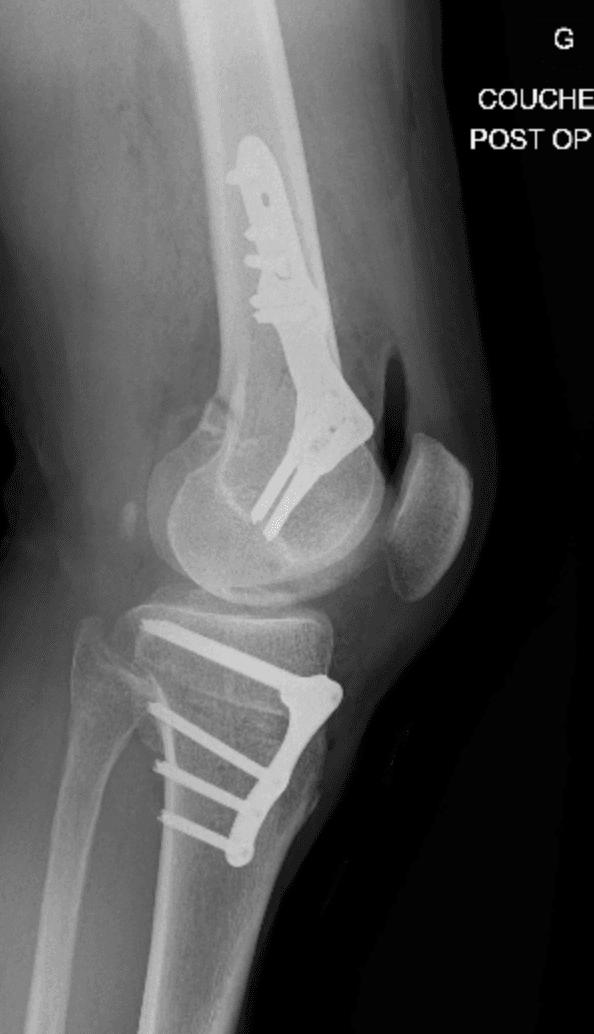 Radiographie de profil après ostéotomie tibiale haute