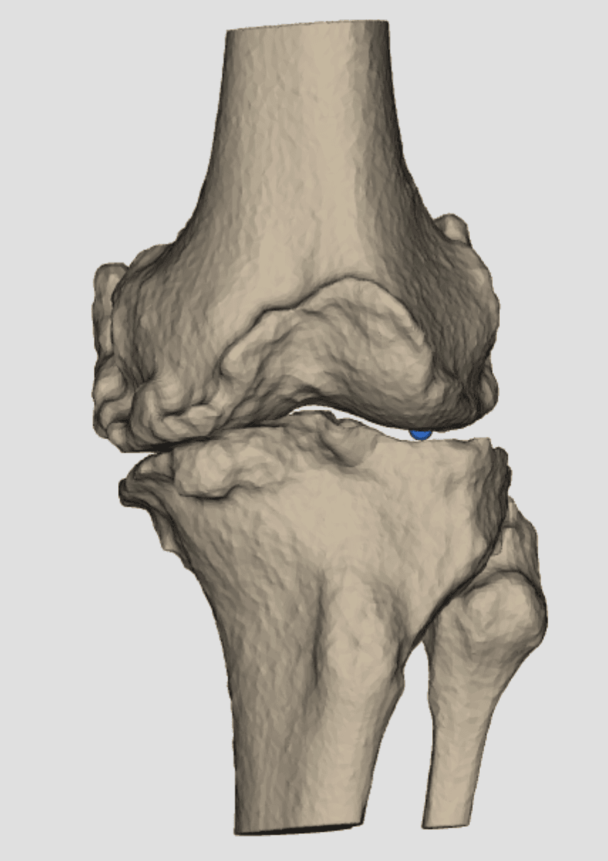 Gonarthrose tri-compartimentale en 3D — indication de prothèse totale