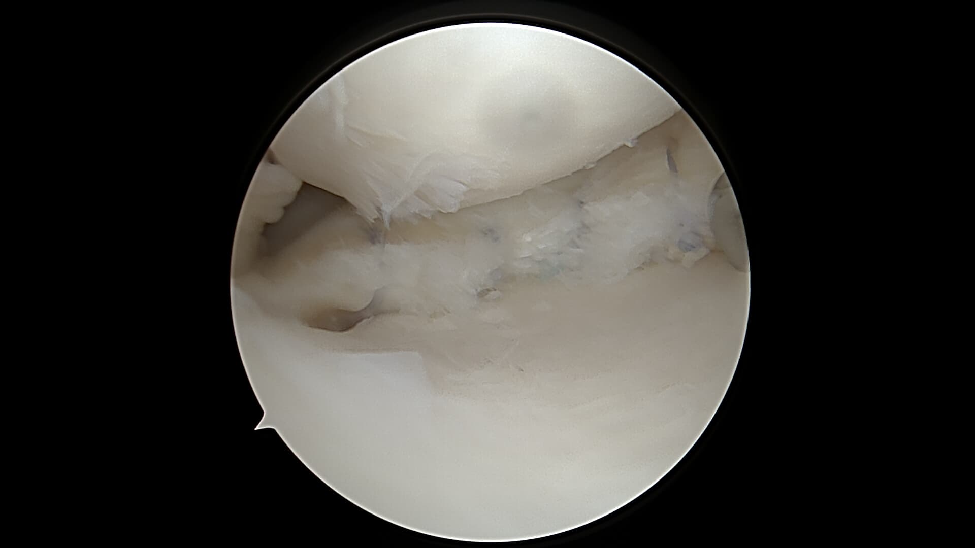 Suture méniscale arthroscopique