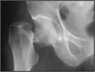 Radiographie d'une fracture du col fémoral déplacée — indication de PIH