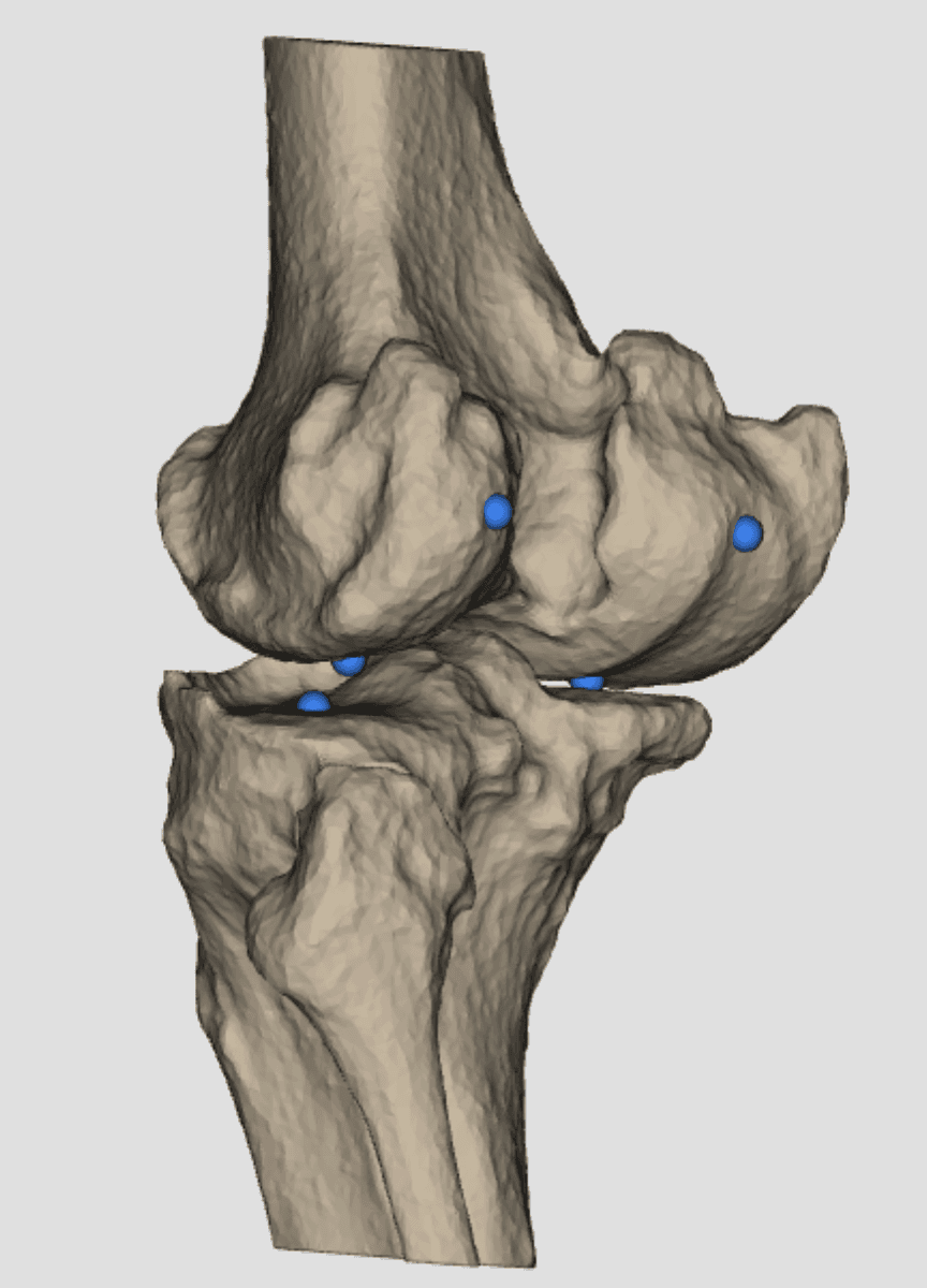 Reconstruction 3D d'une gonarthrose, vue complémentaire