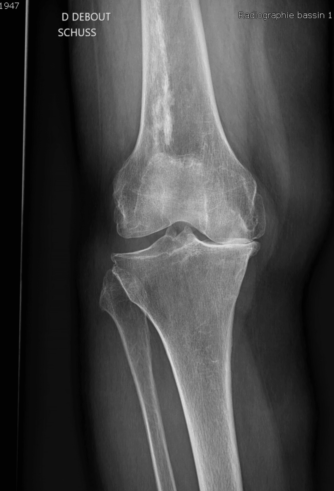 Goniométrie en charge du genou droit gonarthrosique