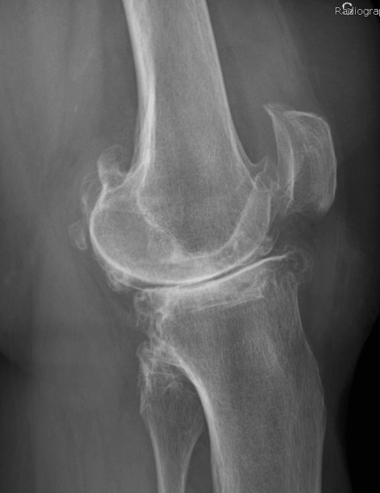 Ostéophytes sur un genou gonarthrosique