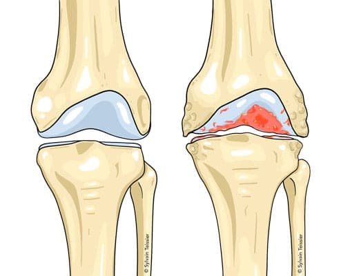 Radiographie d'une gonarthrose
