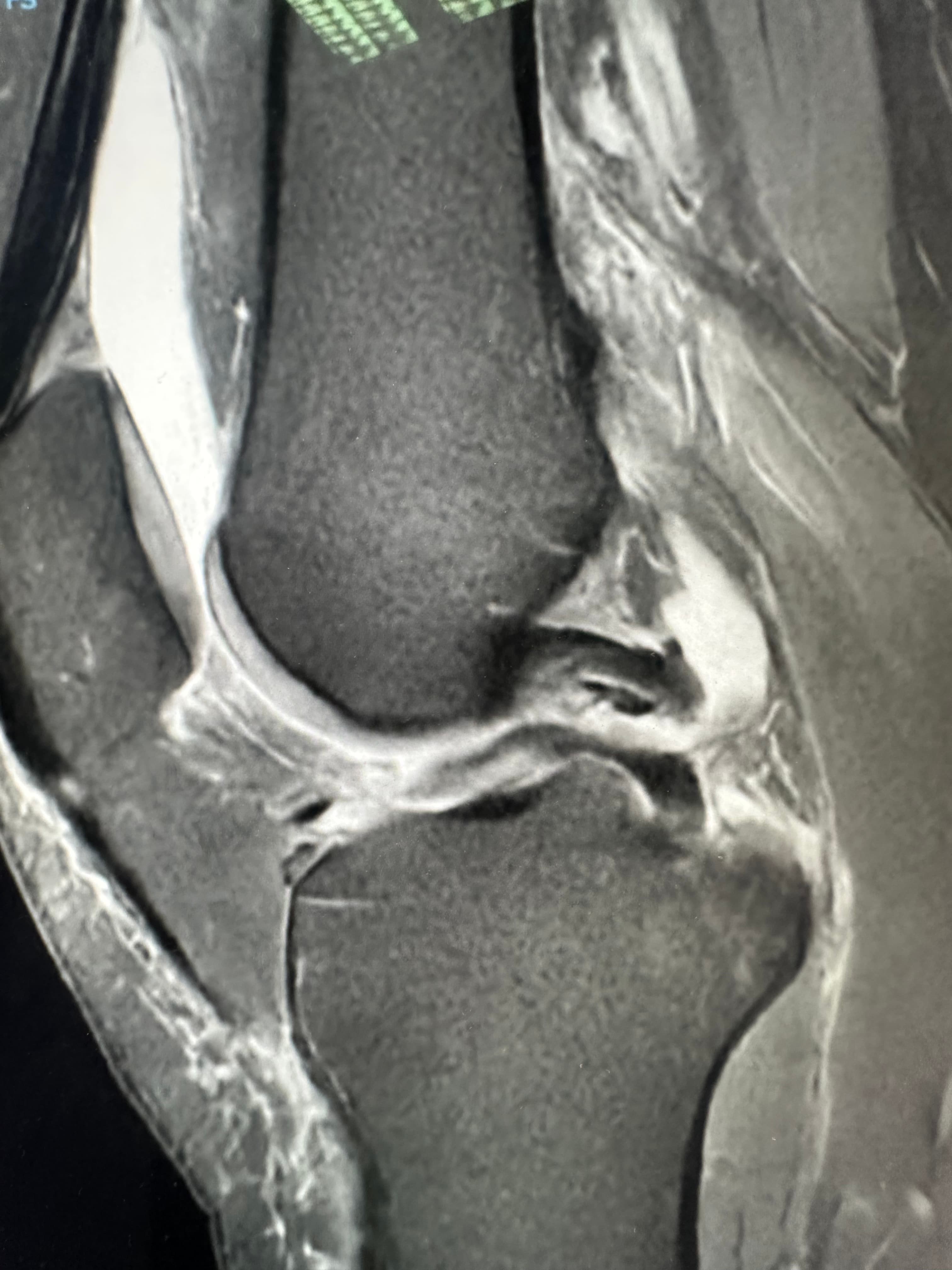 IRM genou montrant le signe du double LCP, caractéristique de l'anse de seau