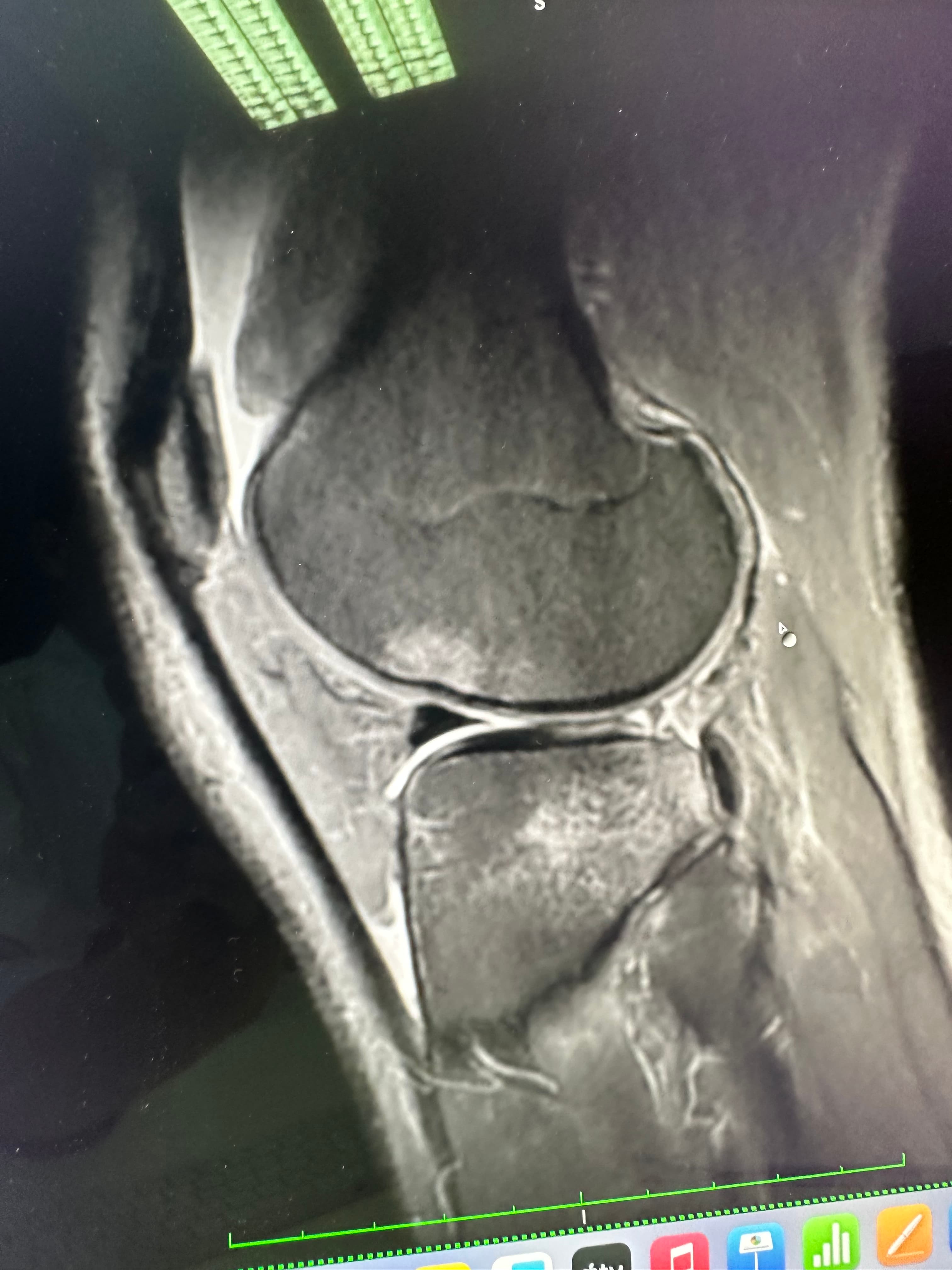 IRM genou montrant le Ghost Meniscus Sign d'une lésion de racine méniscale