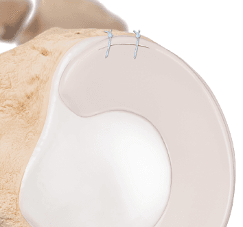 Réparation d'une ramp lésion par deux points de suture