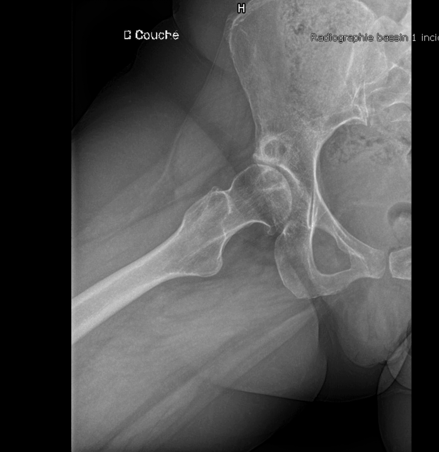 Radiographie de hanche arthrosique en incidence de Dunn