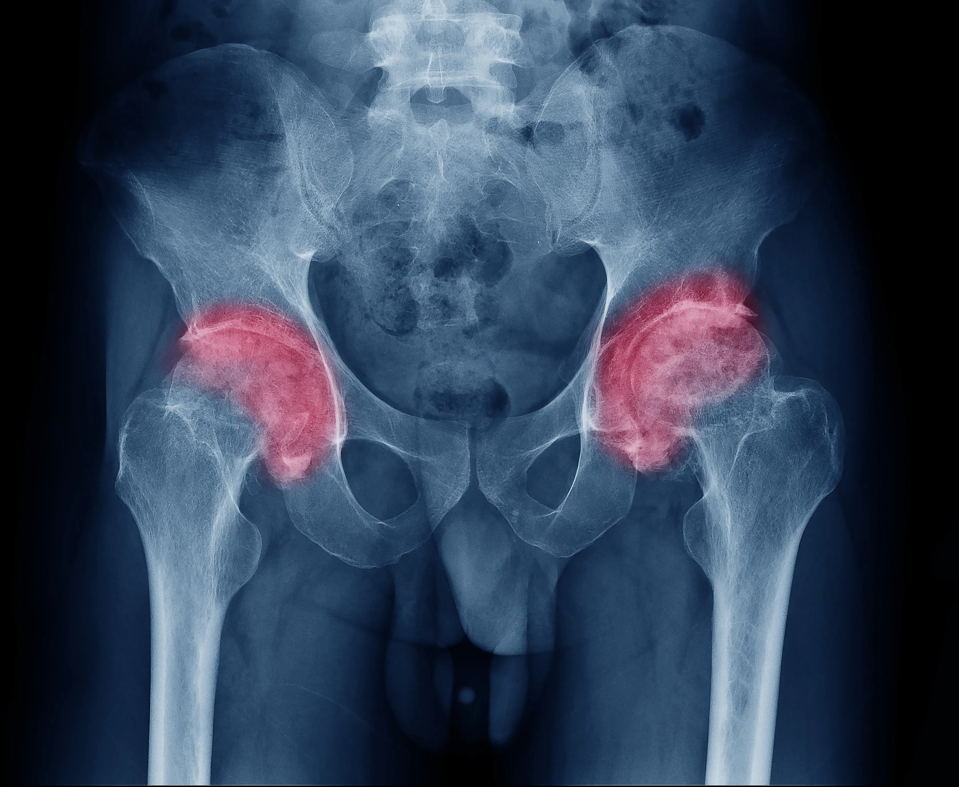 Vue anatomique de coxarthrose bilatérale douloureuse