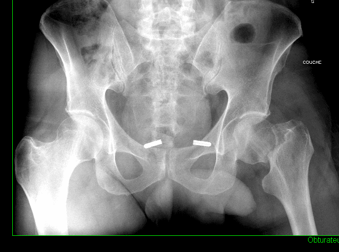 Radiographie de fracture du col fémoral gauche, vue de face