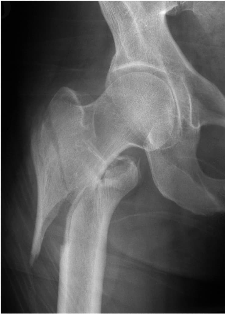 Radiographie de fracture pertrochantérienne, vue 2