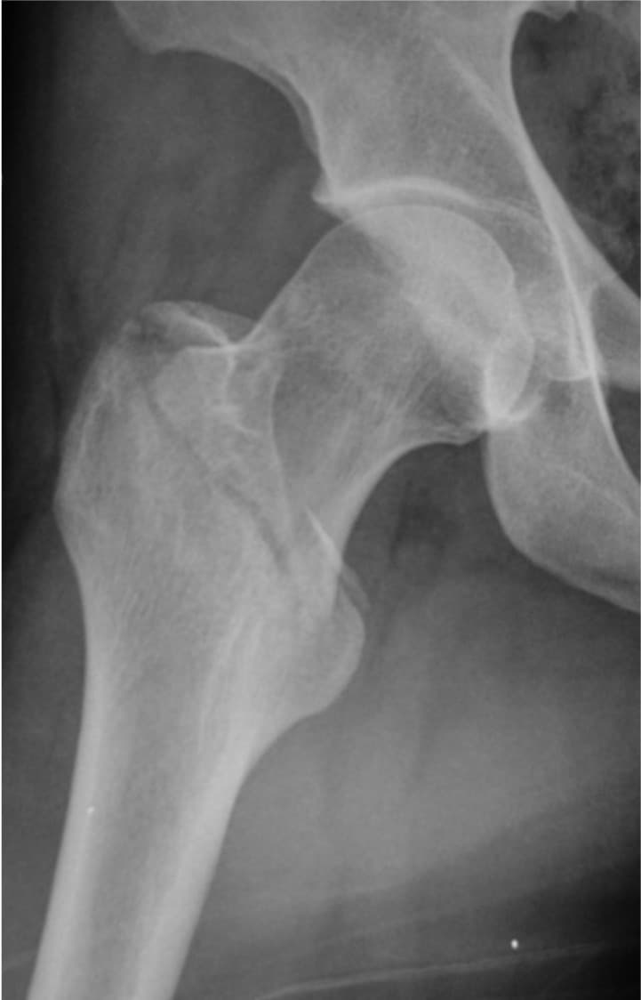 Radiographie de fracture pertrochantérienne de face