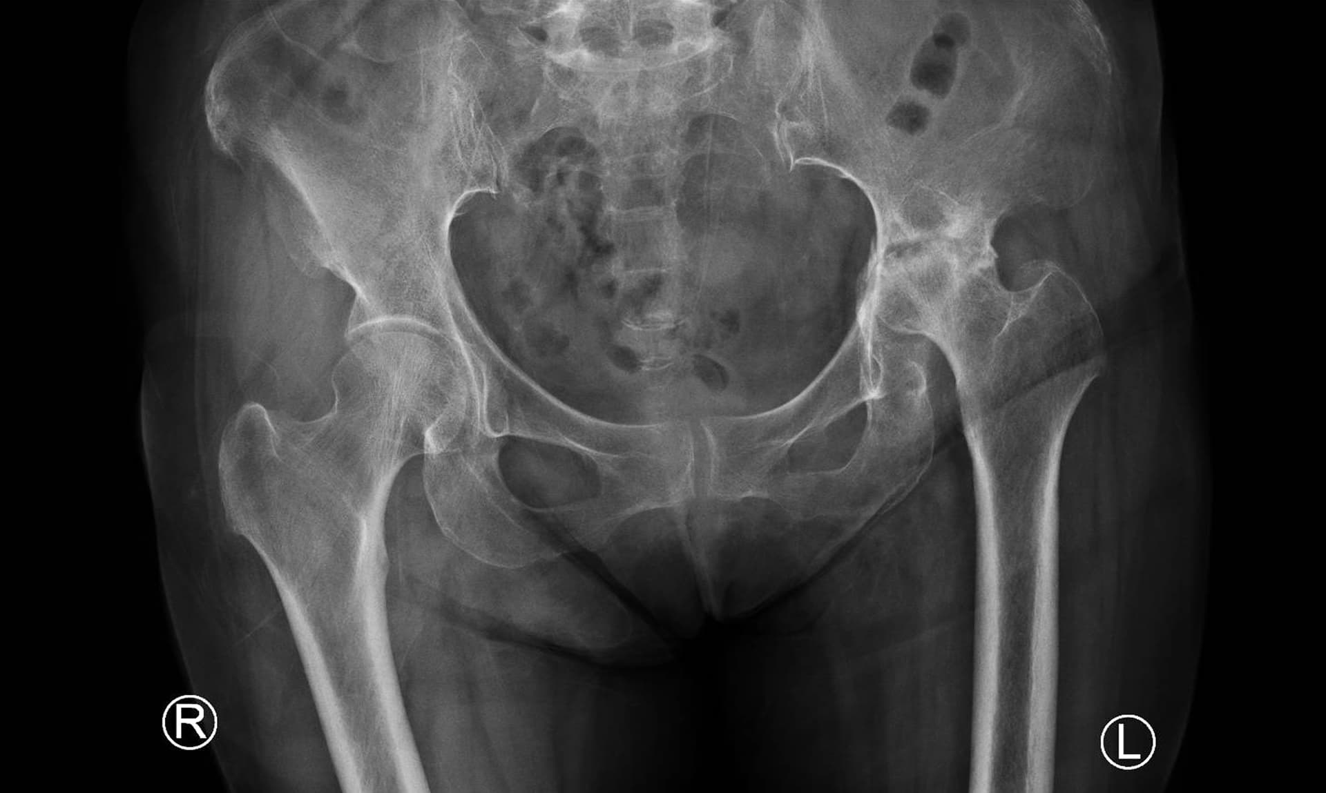 Radiographie d'ostéonécrose de la tête fémorale au stade évolué